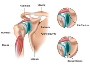 spi-common-labrum-tear1